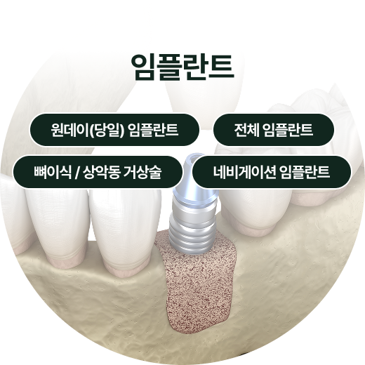 충치/신경치료