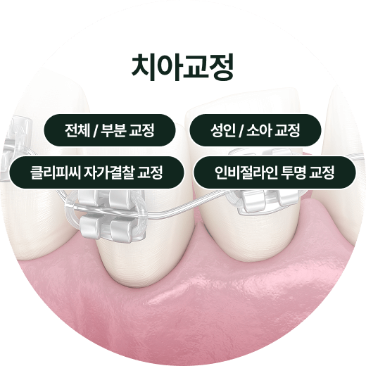 치아교정